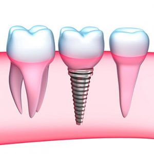 browns line dental services dental implants background image