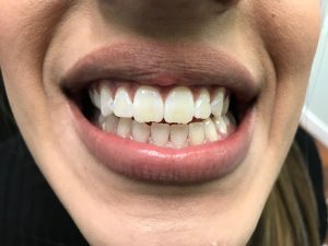 whitening teeth image
