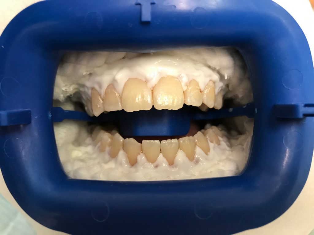 Whitening Teeth