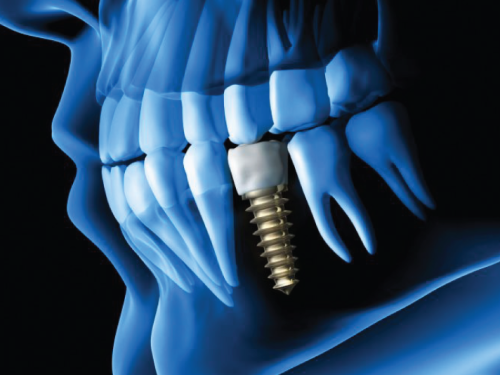 Dental Implants Brown's Line Dental Etobicoke Dentist Toronto