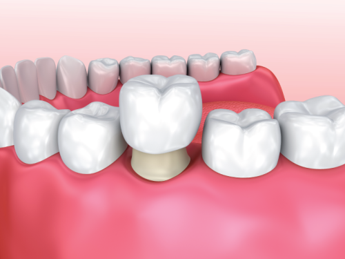 Restoration Brown's Line Dental Etobicoke Dentist Toronto